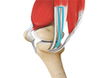 ACL Reconstruction Hamstring Tendon