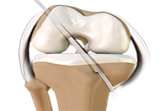 ACL Reconstruction