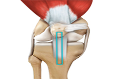 ACL Reconstruction
