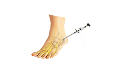 Ankle Arthroscopy