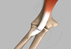 Biceps Tendon Repair 