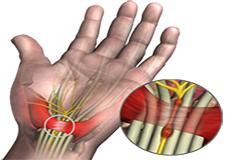 De Quervain’s Tendinosis