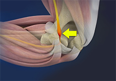 Cubital Tunnel Syndrome