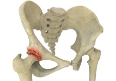 Osteoarthritis of the hip