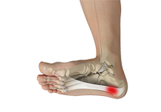 Ankle Sprain