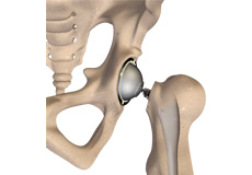 Hip Arthroscopy